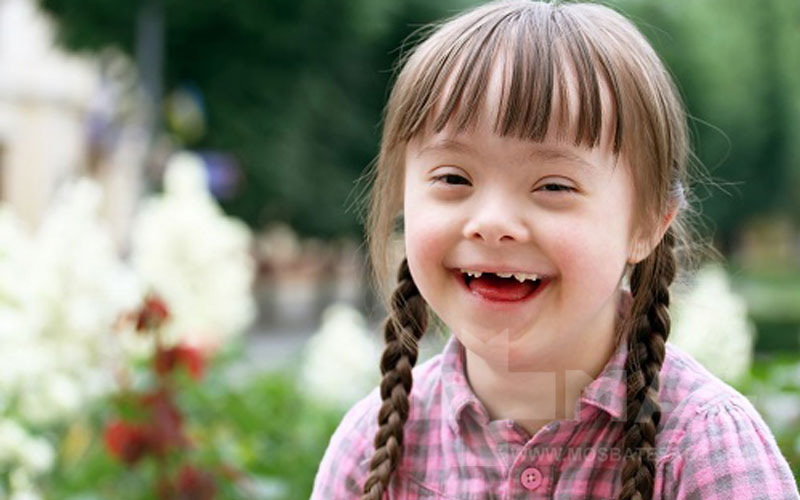 سندروم داون (Down syndrome ) ، در میان اختلالات ژنتیکی نامی آشناست. سندروم داون با ویژگی‌های ظاهری و ذهنی خاص خود شناخته شده است. علائم سندروم داون...